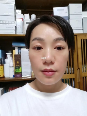 做完射频几天敷面膜？做完射频多久可以上班