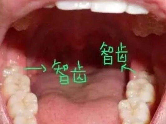 智齿多久长出来？（拔两颗长歪的智齿要多久）